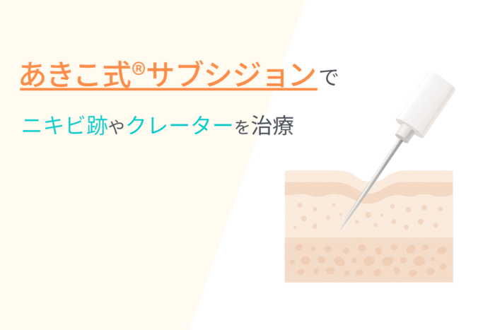 あきこ式®サブシジョンでニキビ跡やクレーターを治療